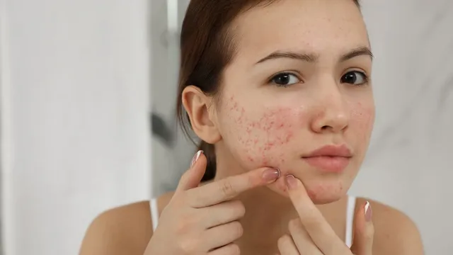 try-these-natural-ways-to-reduce-acne-marks-from-your-face