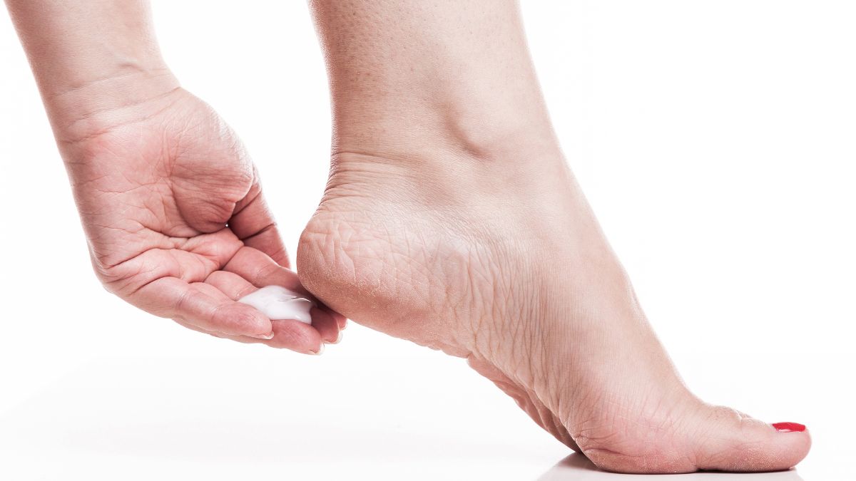 Home Remedies To Get Rid Of Cracked Heels