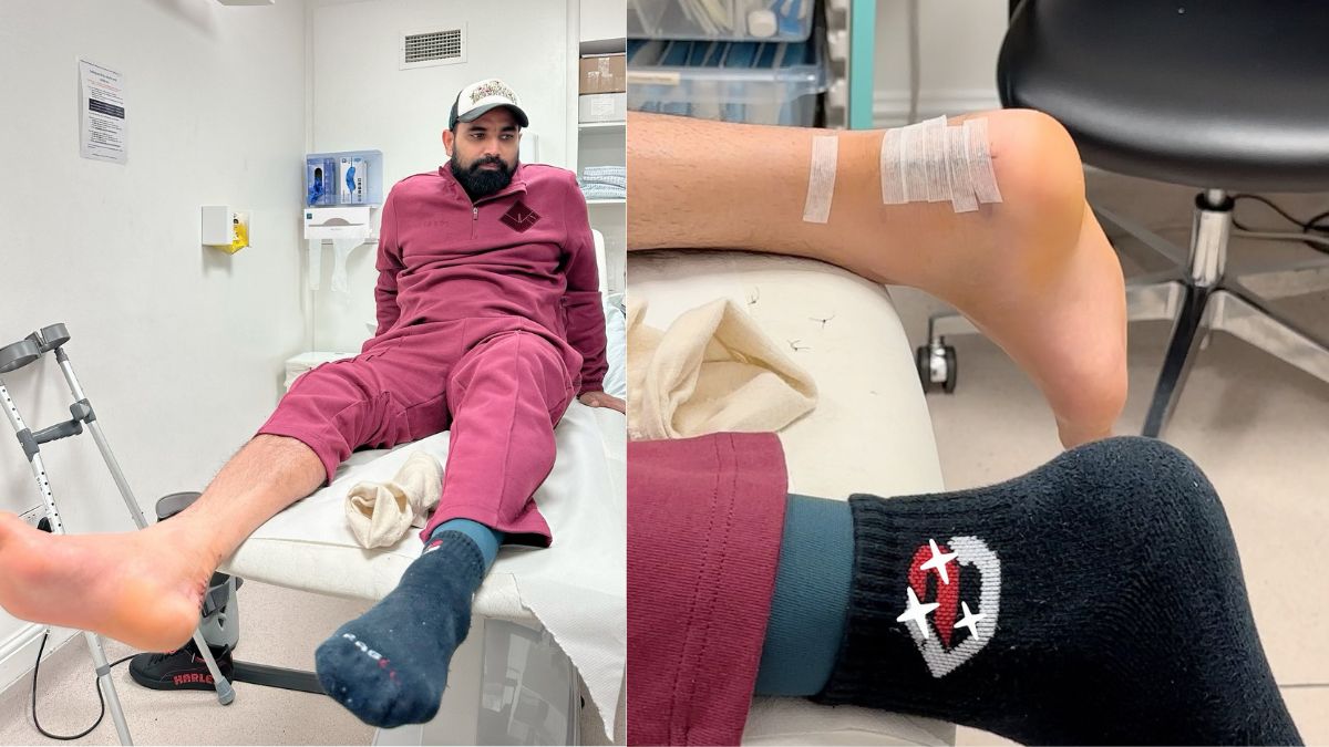 Looking Forward To Next Stage Of My Healing Journey': Mohammed Shami Shares  Update On Ankle Surgery