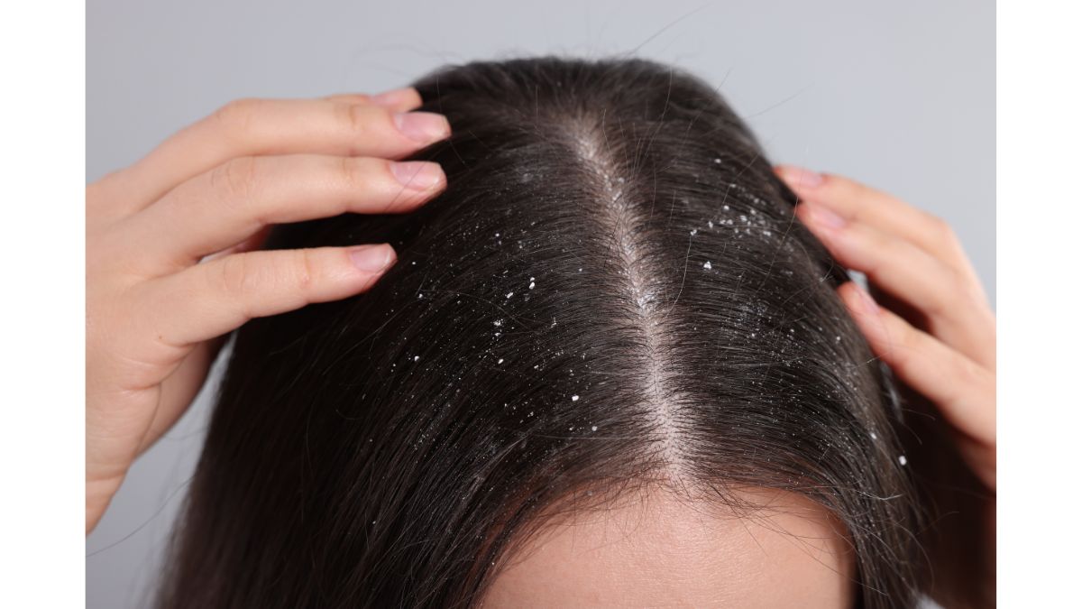 5 Ways In Which Dandruff Affects Your Face