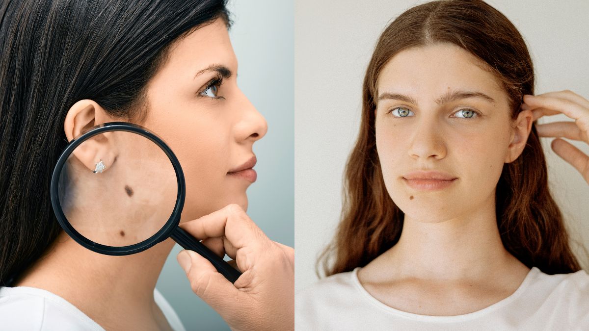 Mole Astrology: Moles On Your Body Can Reveal A Lot About Your ...