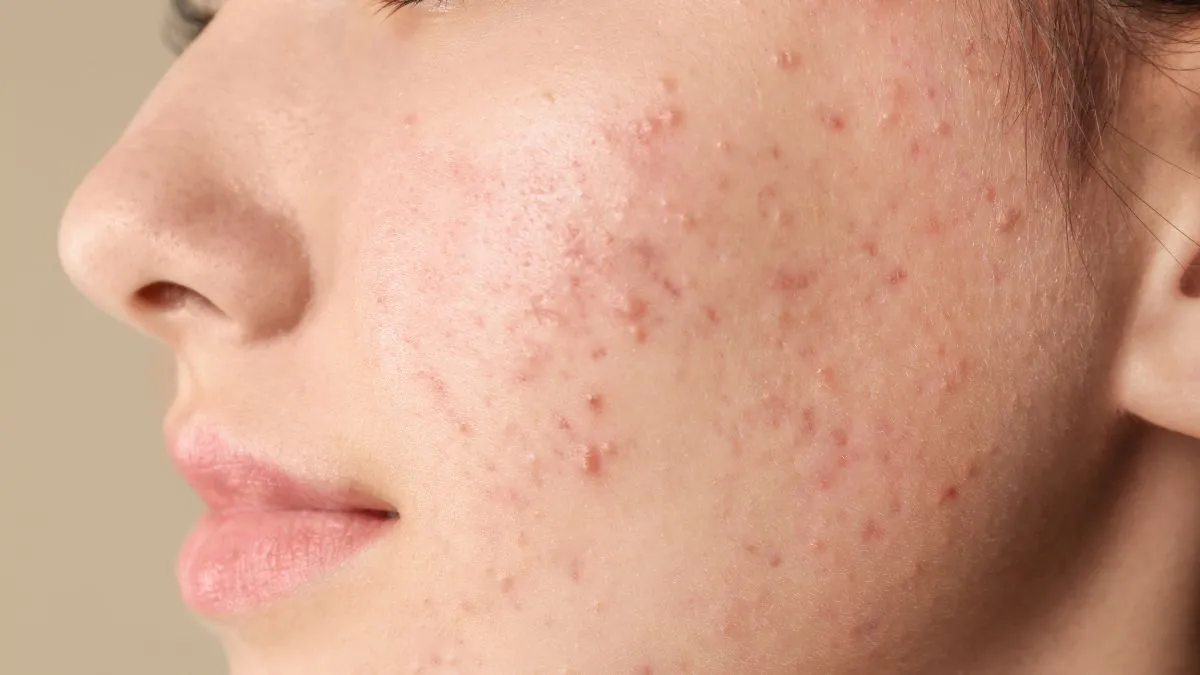5-home-remedies-to-heal-acne-naturally-during-winter