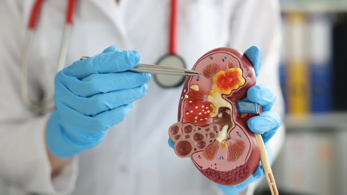 how-obesity-affects-kidney-stone-formation-doctor-lists-easy-tips-to-maintain-healthy-body-weight