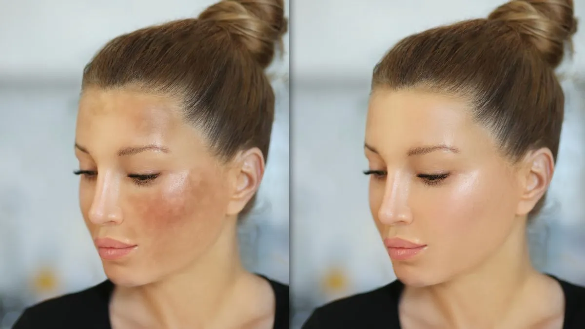 dermatologist-lists-simple-home-care-tips-to-deal-with-hyperpigmentation