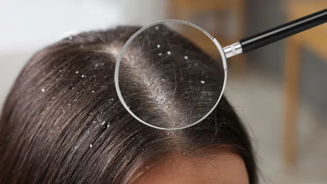 5-simple-ways-to-get-rid-of-dandruff-naturally