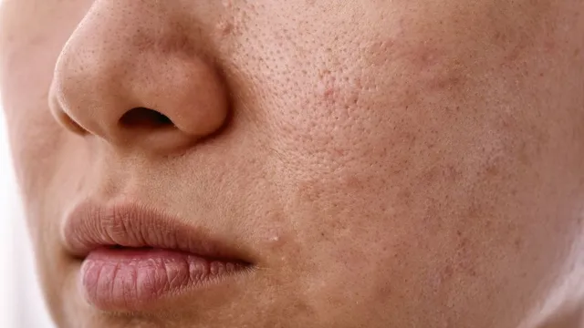 how-stress-can-impact-your-skin-expert-lists-simple-ways-to-keep-your-skin-healthy