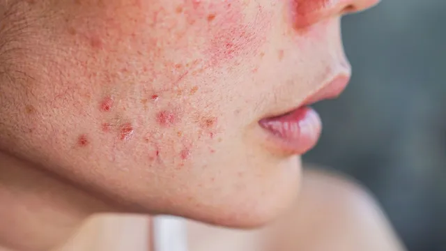 expert-debunks-myths-about-acne-that-you-believe-to-be-true