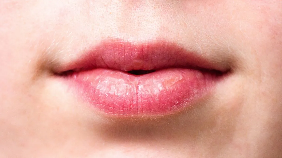 how-to-get-rid-of-darkness-around-mouth-5-diy-hacks-you-can-follow