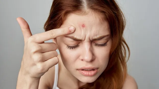 forehead-acne-7-proven-ways-to-prevent-it-before-it-starts-troubling-you