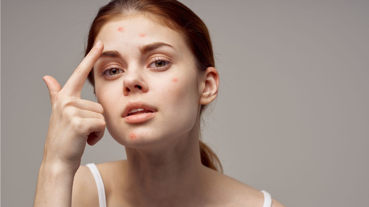 Proven Ways To Prevent Forehead Acne