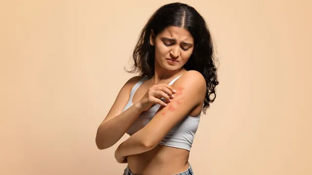 effective-home-remedies-to-relieve-rashes-and-itching-easily