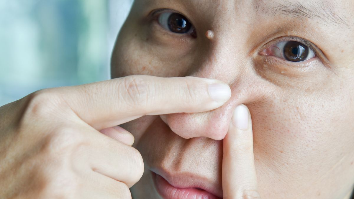 DIY Remedies For Nose Acne