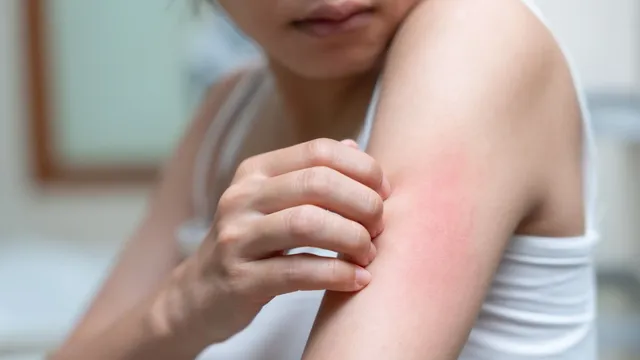 How To Prevent Heat Rash And Skin Irritation In Summer? Dermatologist ...