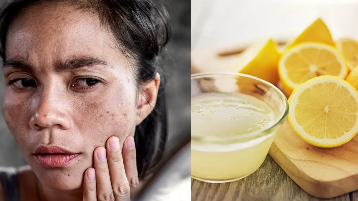5-proven-natural-remedies-to-say-goodbye-to-dark-spots-at-home