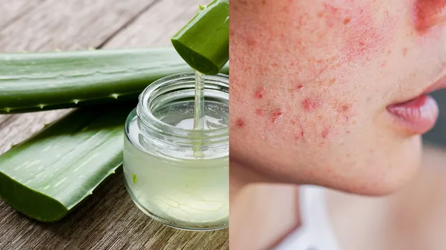 5-powerful-home-remedies-to-say-goodbye-to-acne-scars