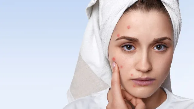 why-adult-acne-is-rising-cosmetologist-shares-tips-to-treat-it-naturally