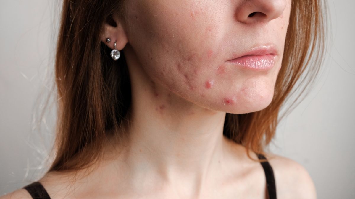 Tips To Treat Adult Acne