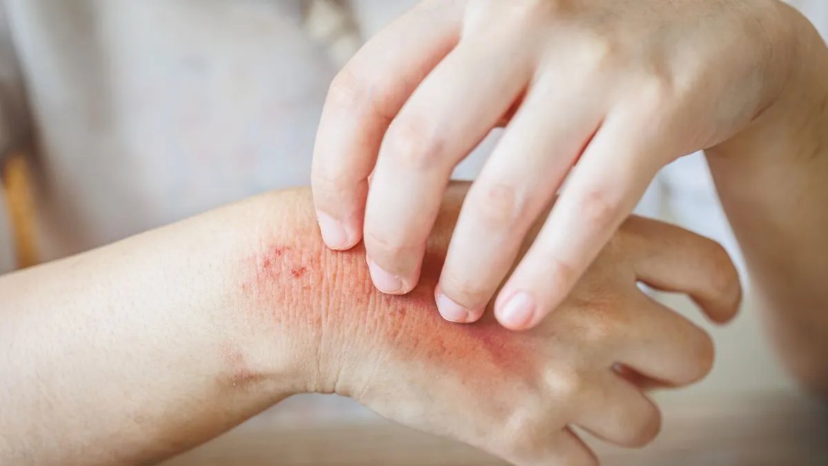 how-to-prevent-fungal-infections-in-summer-doctor-shares-simple-tips-to-stay-safe