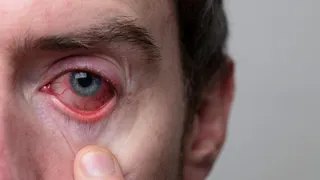 How Can You Tell If Red Eyes Are Due To Allergic Conjunctivitis? Know From Doctor
