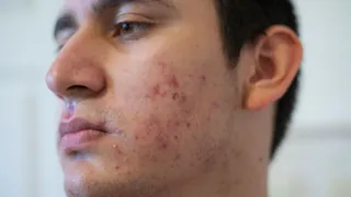 What Are The Common Skin Problems In Men And How To Manage Them? Know From Doctor