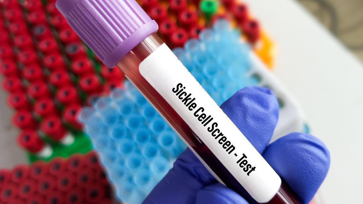 Sickle Cell Disease  (1)