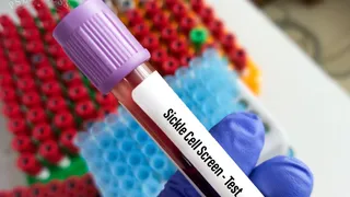 Doctor Shares 6 Things Everyone Should Know About Sickle Cell Disease