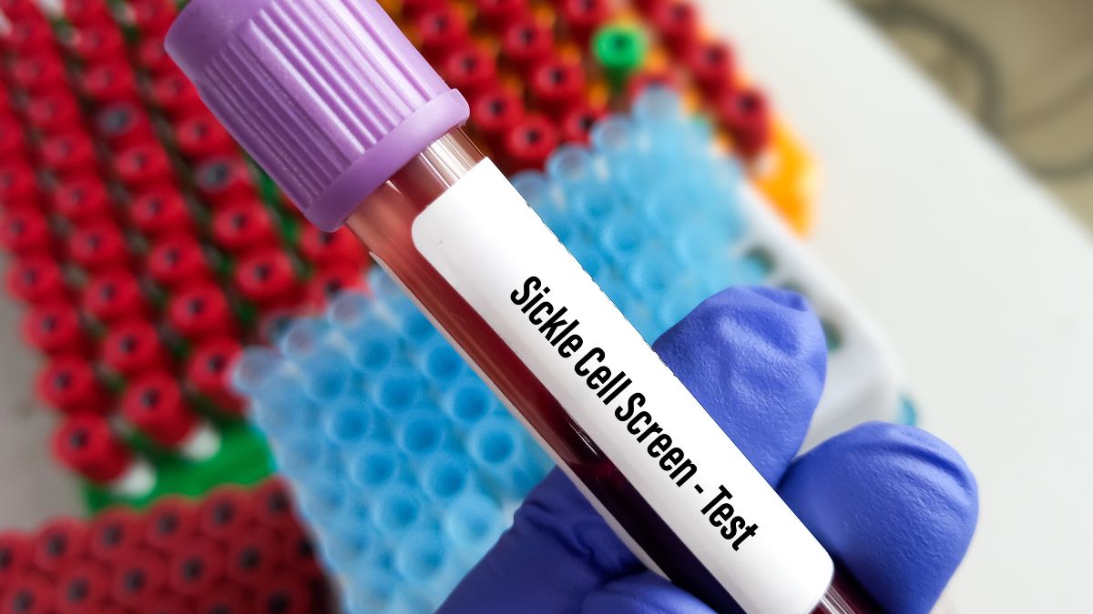 Sickle Cell Stroke Prevention