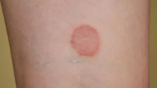 Why Fungal Infections Like Ringworm Spike During Monsoon? Doctor Shares Simple Prevention Tips