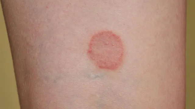 why-fungal-infections-like-ringworm-spike-during-monsoon-doctor-shares-simple-prevention-tips