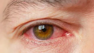 Eye Infections Rise In Monsoon: 7 Expert-Approved Tips To Protect Your Vision
