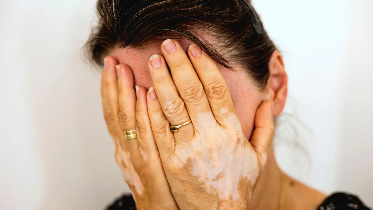 is-vitiligo-contagious-or-infectious-experts-busts-the-myth