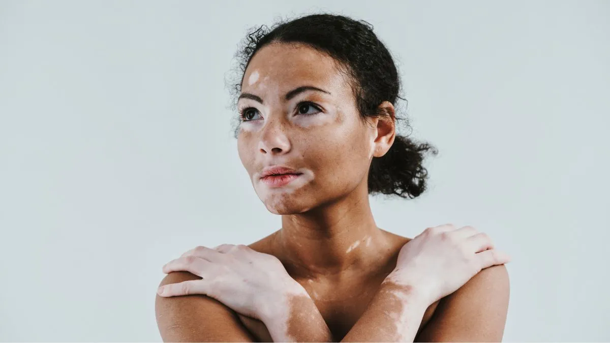 world-vitiligo-day-2025-doctor-explains-vitiligo-health-tips-treatment-options-and-more