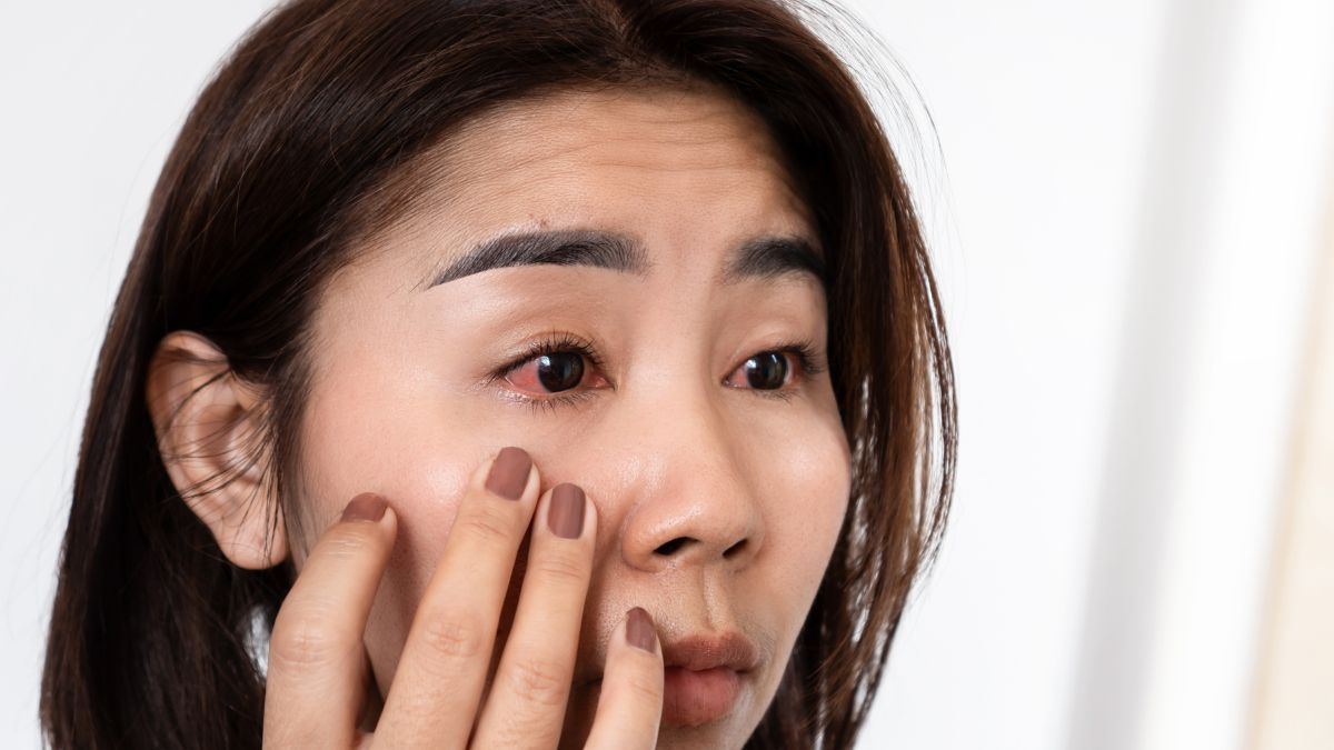 rose water for dry itchy eyes