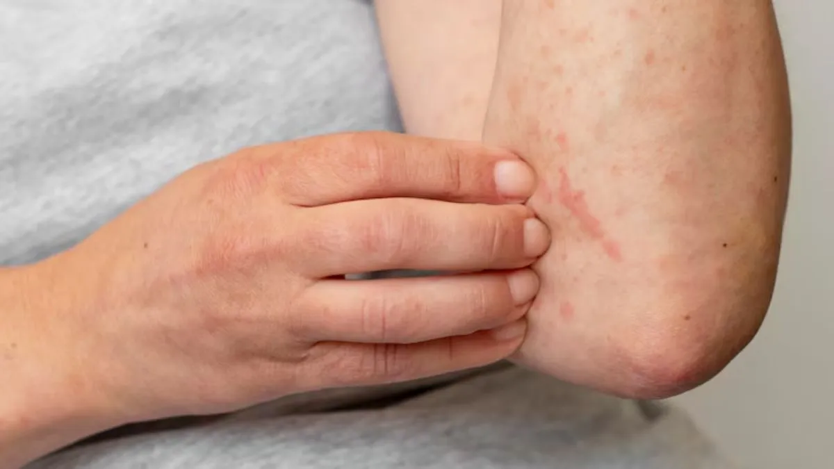 us-measles-outbreak-new-mexico-county-facility-under-quarantine-jail-inmates-at-risk