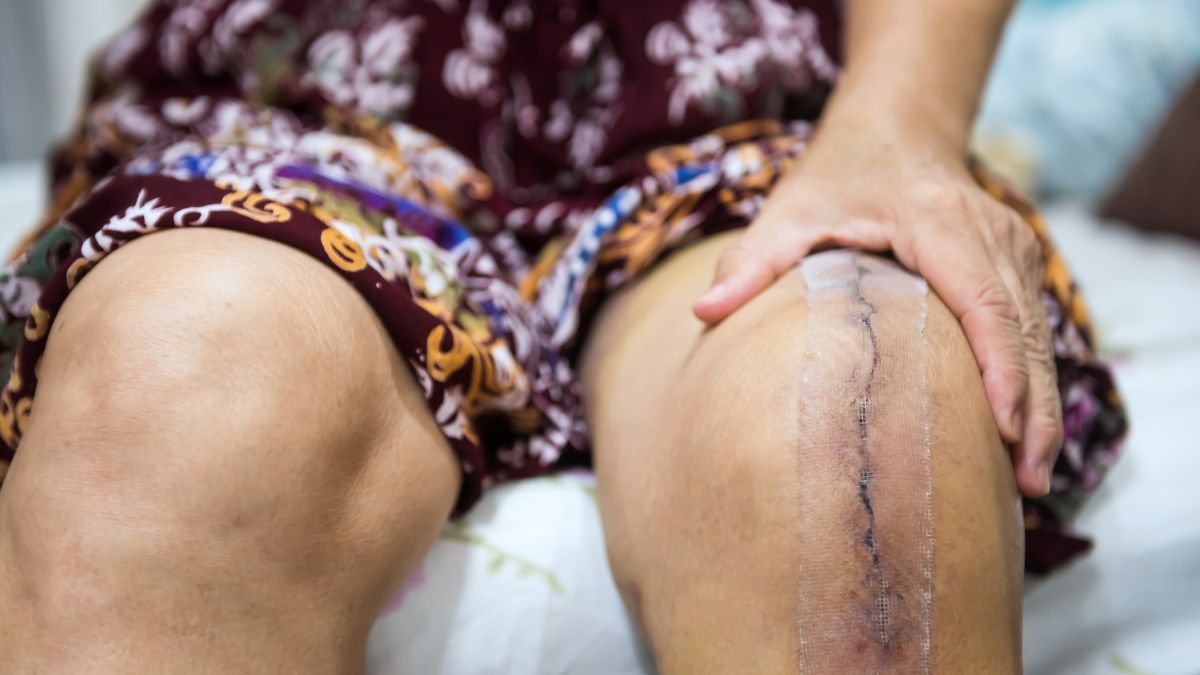 Doctor Debunks Joint Replacement Myths That Every Person Should Know ...