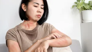 How To Treat And Prevent Heat Rashes In Summer? Know From Expert