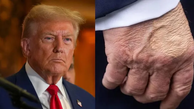 Trump's Mysterious Hand Bruise And Swollen Ankle Spark Fresh Health Concerns
