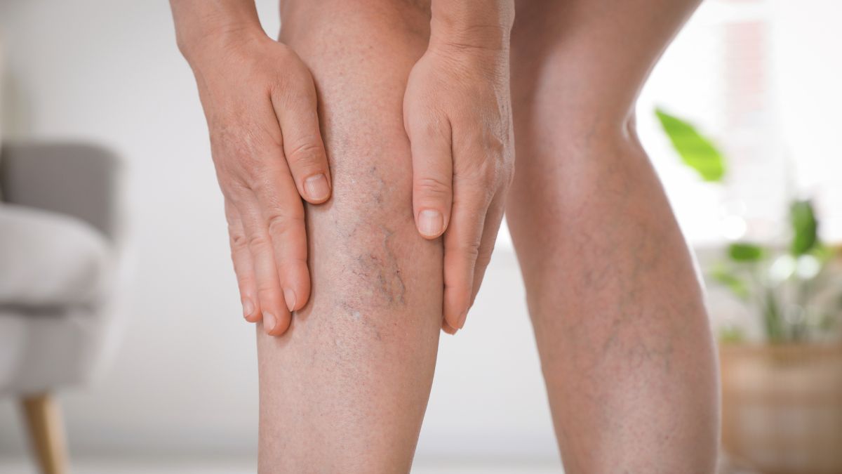 Chronic Venous Insufficiency