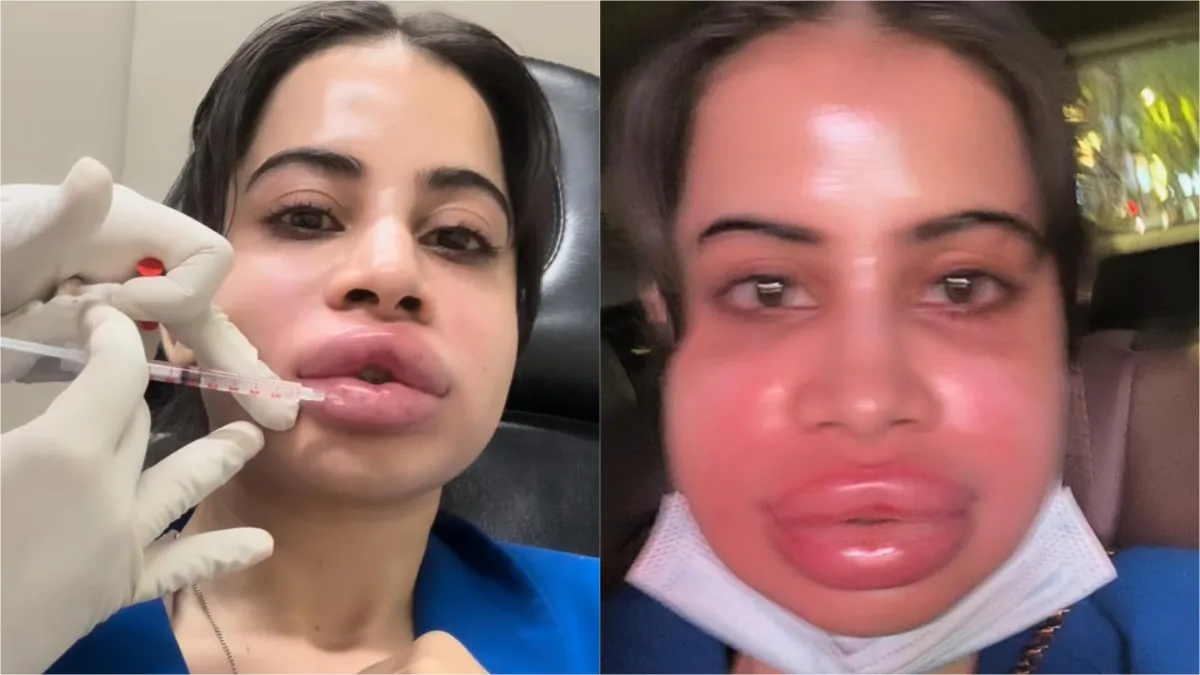 urfi-javed-looks-unrecognisable-after-dissolving-lip-fillers-says-will-get-them-again-shocking-video