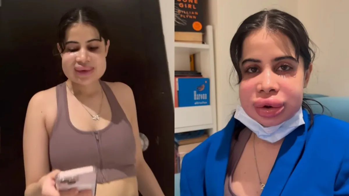 urfi-javed-humorous-take-on-her-swollen-face-after-dissolving-lip-fillers-shares-her-boyfriend-epic-reaction