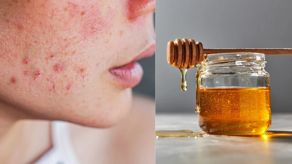 heal-scars-with-top-5-ingredients-from-your-kitchen-to-get-clearer-skin