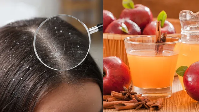 5-best-diy-treatments-to-remove-dandruff-naturally-this-monsoon