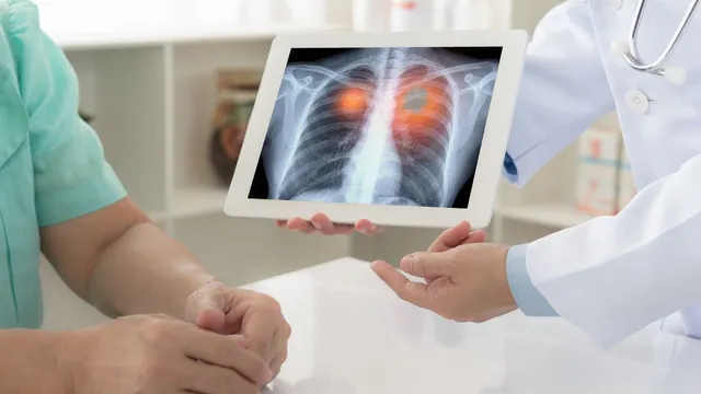 lung-cancer-in-young-adults-signs-risk-factors-and-how-to-detect-it-early-insights-from-doctor