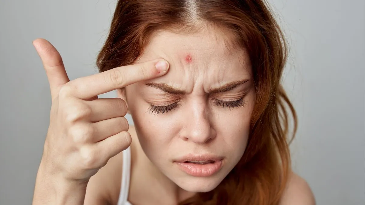why-do-pimples-flare-up-with-weather-changes-know-causes-and-remedies-from-dermatologist