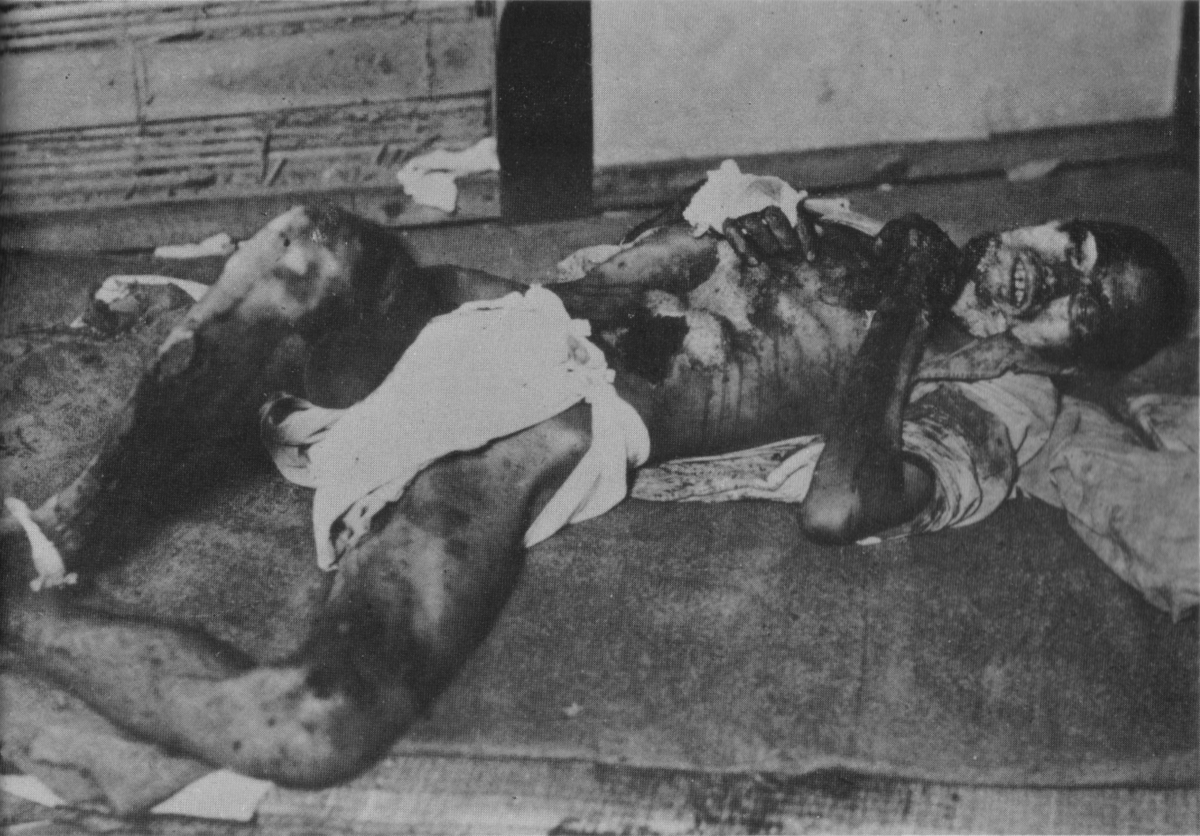 Victim Of Hiroshima And Nagasaki Bombing