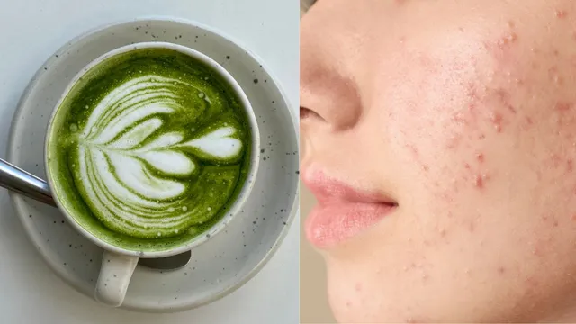 how-anti-inflammatory-benefits-of-matcha-support-acne-prone-skin-dermatologist-explains