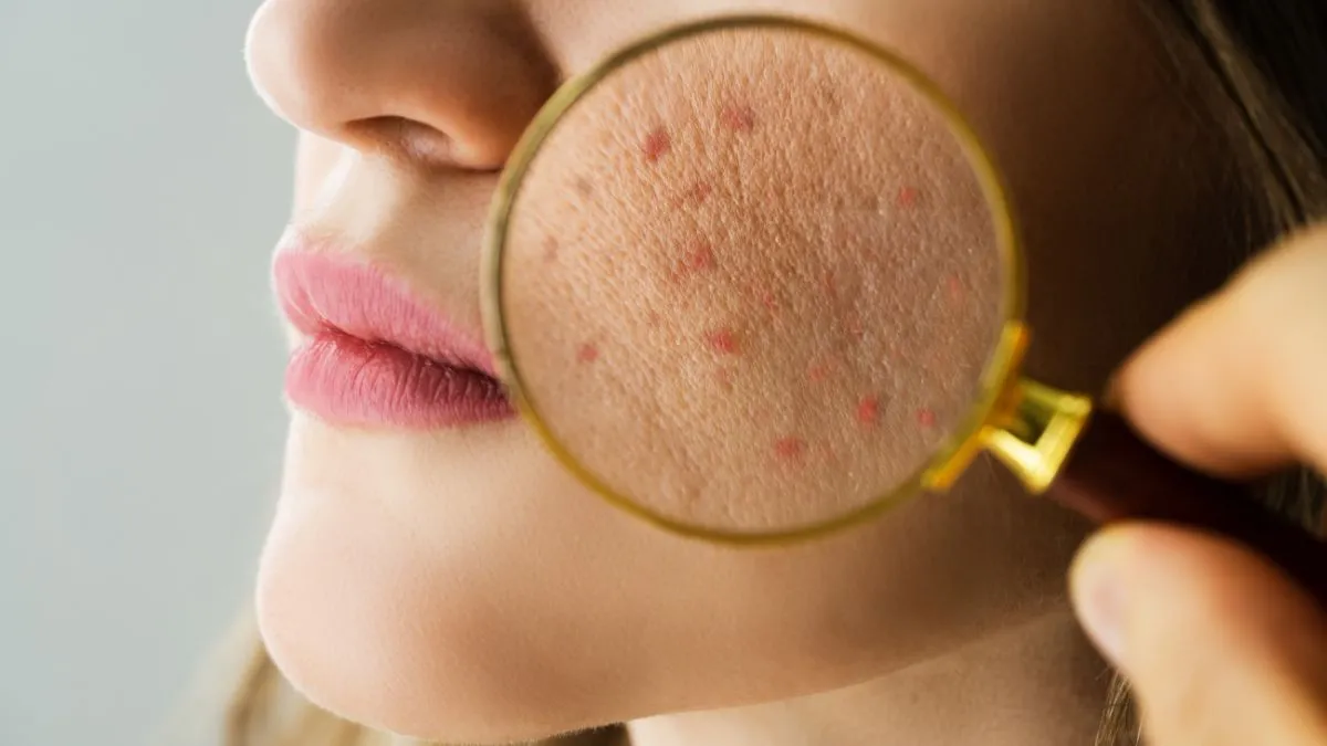 skin-purging-vs-breakouts-doctor-tells-the-difference-and-how-to-save-your-skincare-routine