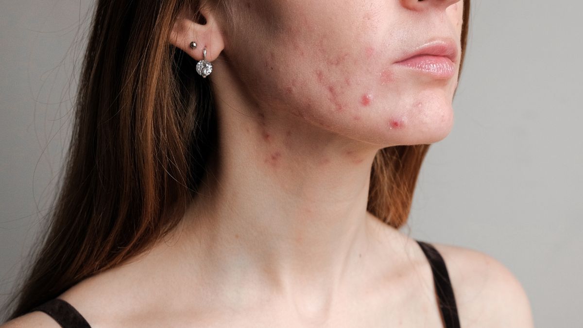 Skin Purging vs Breakouts (1)