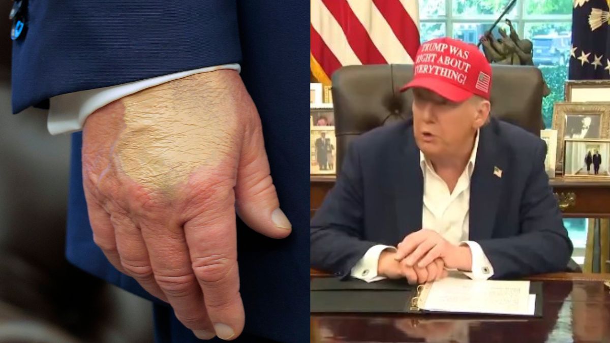 bizarre-makeup-bruises-and-swelling-trumps-health-concerns-resurface-after-cankles-scandal
