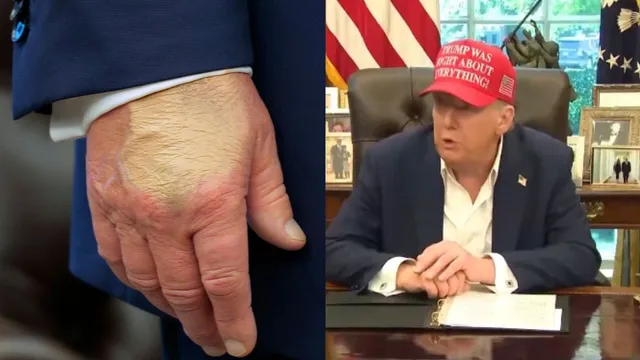 bizarre-makeup-bruises-and-swelling-trumps-health-concerns-resurface-after-cankles-scandal